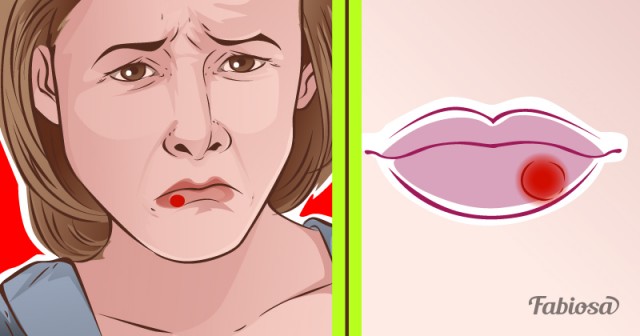 Что делать, если выскочила простуда на губах