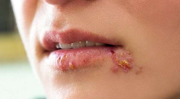 Герпес на губах: причины, терапия и меры профилактики